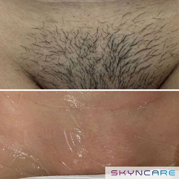 Before and after of bikini line hair removal in North Wales