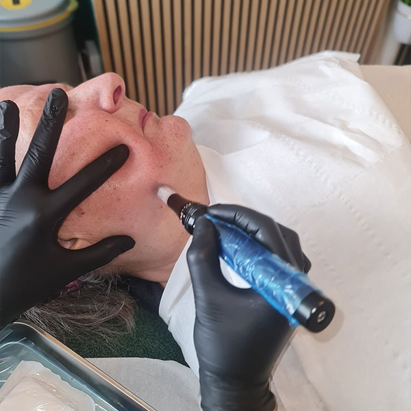 Facial regeneration treatment