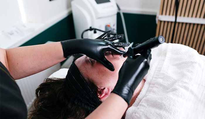 Woman receiving microneedling in Ruthin